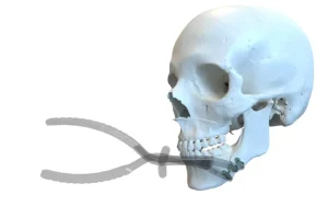 placa e alicate x placa e alicate x