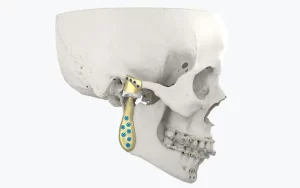 cranio maxillofacial temporomandibular personalized implant cranio maxillofacial temporomandibular personalized implant