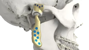 CMF TMJ rendering x CMF TMJ rendering x